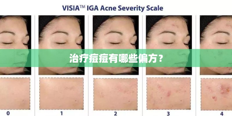 治疗痘痘有哪些偏方？